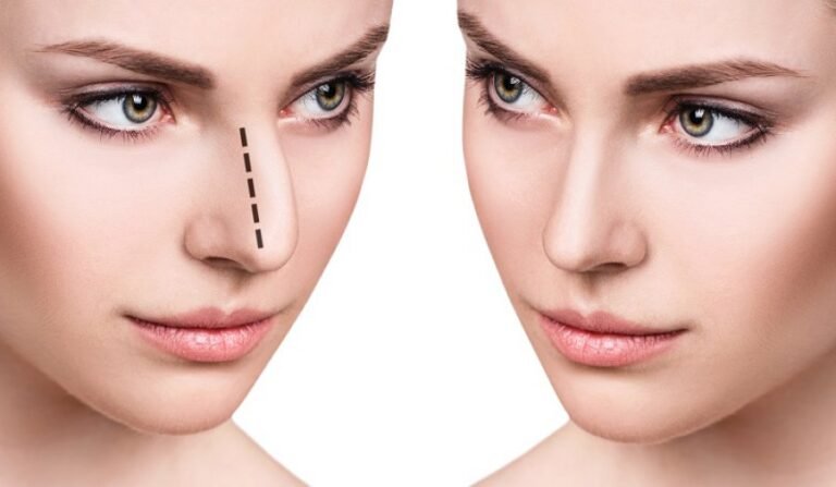 Aesthetic-or-Medical-Problems-That-Rhinoplasty-Can-Solve